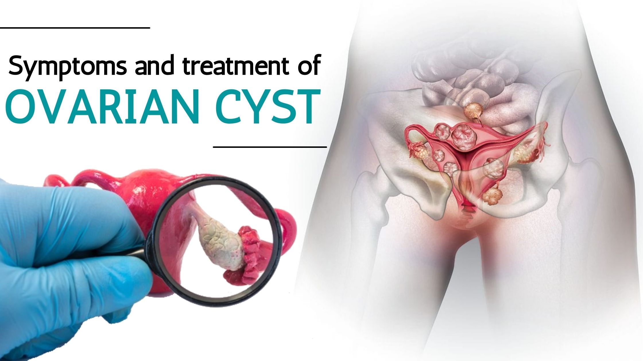 Ovarian Cyst: Symptoms, Treatment & Common Doubts - Tua Saúde